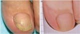 Resultado antes y después tratamiento anti hongos